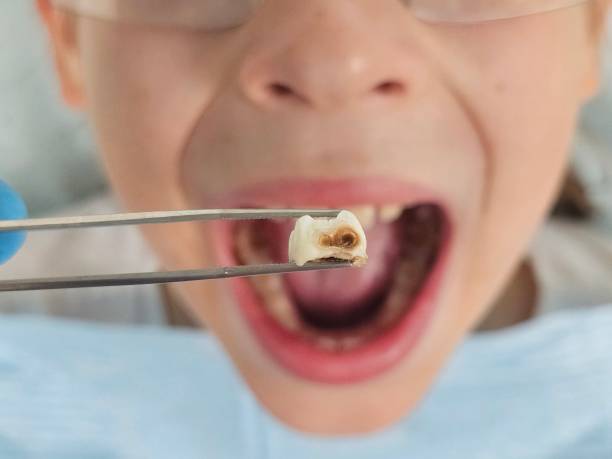 Best Emergency Root Canal Treatment in China Lake Acres, CA